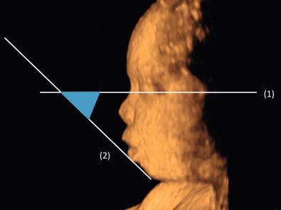 FIG 11-30, Inferior facial angle obtained from a sagittal view of the fetal face. The angle is formed by a reference line (1), orthogonal to the vertical part of the forehead at the level of the synostosis of the nasal bones, and the profile line (2), joining the tip of the mentum to the anterior border of the more protruding lip.