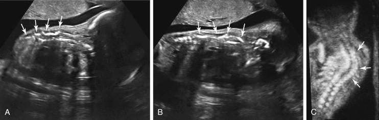 F igure 19-3, Abnormal spine: scoliosis due to vertebral segmentation defects. Sagittal images of cervicothoracic (A) and thoracolumbar (B) spine in a second trimester fetus reveal spine abnormalities at multiple levels (arrows) . Compare with Fig. 15-43 A and B, which demonstrates the normal appearance of the fetal spine in the sagittal scan plane. C, 3D coronal reconstruction of the spine of the same fetus as in A and B shows lateral curvature consistent with scoliosis (arrows) .