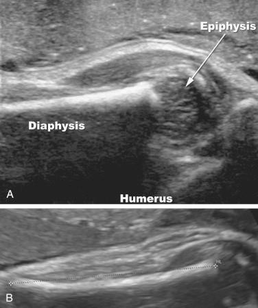 FIG 11-3, A, Proximal humeral epiphysis imaged with a high-frequency linear transducer (10 MHz) in a fetus at 29 weeks' gestation. B, Measurement of the femur in a third trimester. The femur should be measured along the ossified bone (between the electronic calipers).