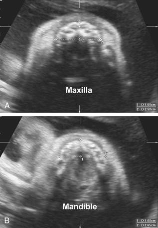 FIG 11-31, The mandible/maxilla (MD/MX) ratio is calculated using transverse sections of the mandible ( B ) and maxilla ( A ), with measurements performed 10 mm posterior to the anterior osseous border.