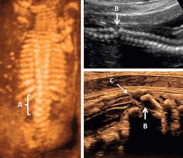 FIG 11-32, Spinal dysgenesis showing complex vertebral segmentation between the thoracic and lumbar segments (A), obliteration of the spinal canal (B), and tethered spinal cord (C).