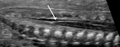 FIG 11-33, Conus medullaris ( arrow ) in a fetus at 21 weeks of gestation.