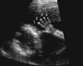 F igure 19-4, Open hand: normal. Open view of the hand during the second trimester shows all five fingers. ( T, thumb; 1, 2, 3, and 4, other fingers).