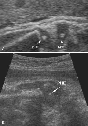 FIG 11-4, A, Sonogram of the knee in a fetus at 35 weeks' gestation. Increased echogenicity from the secondary ossification centers of distal femoral (DFE) and proximal tibial (PTE) epiphyses are seen. B, Sonogram of the proximal humerus in a fetus at 38 weeks' gestation. Ossification of the proximal humeral epiphyseal ossification center (PHE) is noted.