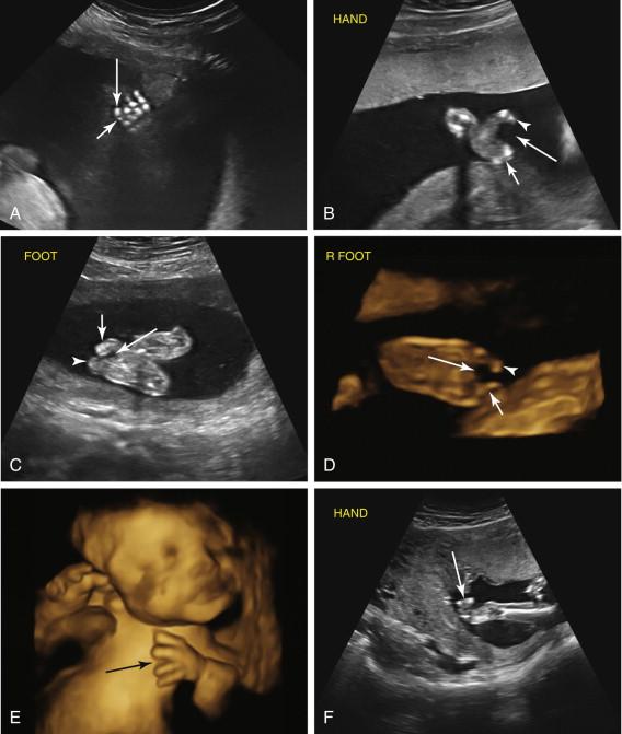 F igure 19-6, Hand abnormalities. A, Clinodactyly. Open view of the hand shows inward angling of the fifth digit (long arrow) due to hypoplasia of the middle phalanx (short arrow) . Although clinodactyly was an isolated finding in this fetus, it also occurs in trisomy 21 and other aneuploidies. B to D, Ectrodactyly in the hand (B) and feet (C and D). Oblique view of the hand ( B ) shows the absence of central digits (long arrow) with separation of the thumb (arrowhead) from the remaining digits (short arrow) , resulting in an appearance termed a lobster-claw deformity. Image of the foot of the same patient ( C ) and three-dimensional (3D) surface-rendered image of the foot in a different patient ( D ) also show ectrodactyly, characterized by the absence of central toes (long arrows), resulting in separation of the big toe (arrowheads) from the remaining digits (short arrows) . Ectrodactyly is also referred to as split hand and split foot. E, Trident hand. 3D surface-rendered image of a fetus with a skeletal dysplasia shows a gap (arrow) between third and fourth fingers. The fingers are short and similar in length to each other. Trident hand is associated with achondroplasia. F, Clenched hand. Image of the hand of a fetus with trisomy 18 shows clenched hand (arrow) . The fingers remained in this position throughout the study and the hand never opened, a common finding in trisomy 18. Overlapping digits are also a typical hand abnormality seen in trisomy 18.