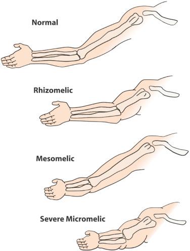 FIG 11-6, Varieties of short limb dysplasia according to the involved segment.