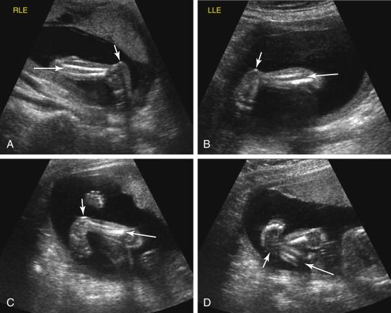 F igure 19-7, Clubfoot. A and B, Unilateral clubfoot. Image of the right lower leg and foot (A) in a second-trimester fetus shows normal orientation of the right foot (short arrow) relative to the tibia and fibula (long arrow) . Image of the left lower leg (B) in the same fetus shows abnormal angulation of the foot at the ankle due to clubfoot, with visualization of the entire heel in the coronal scan plane (short arrow) even though a substantial portion of the tibia and fibula is seen in long axis (long arrow) . C and D, Bilateral clubfeet. Images of both feet show abnormal angulation between the feet (short arrows) and lower leg (long arrows) due to bilateral clubfeet in a fetus with Chiari II malformation and spina bifida. Both feet remained fixed in this position throughout the study.