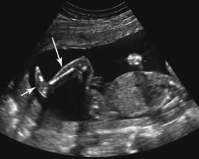 F igure 19-8, Rocker-bottom foot. Longitudinal image of the lower leg (long arrow) and foot in a second-trimester fetus with trisomy 18 reveals a convex plantar surface of the foot (short arrow) consistent with rocker-bottom foot, a configuration commonly associated with trisomy 18 but also occasionally seen in trisomy 13.