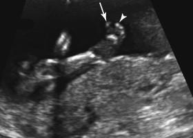 F igure 19-9, Sandal gap toe. Oblique coronal image of the foot in a second-trimester fetus with trisomy 21 shows a prominent gap between the big toe (arrow) and second toe (arrowhead) . This configuration can be seen in both trisomy 21 and normal fetuses.