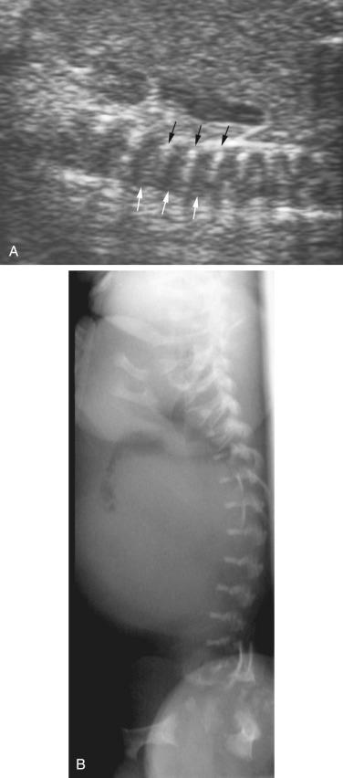 FIG 11-9, A, Longitudinal scan of the spine in a fetus with thanatophoric dysplasia and platyspondyly. The intervetebral disks ( white arrows ) are greater in height than the vertebrae ( black arrows ), which are flat. B, Lateral spine radiograph from a fetus with platyspondyly and thanatophoric dysplasia. Note the markedly flattened vertebrae.