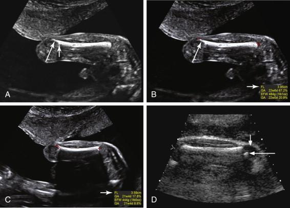 F igure 19-10, Distal femur point. A, Coronal image of the femur shows a hyperechoic, linear specular reflector (long arrow) extending for a short distance from the inferior edge of the femoral diaphysis (short arrow) . This line is termed the distal femur point and should not be included in the femur length measurement. B, Femur length (red calipers) obtained with inclusion of the distal femur point (long arrow) in the measurement results in a spuriously long length of 3.95 cm (short arrow) consistent with 22 weeks 6 days. C, Femur length (red calipers) in the same fetus as in B, obtained without including the distal femur point results in the correct measurement of 3.59 cm (short arrow) , which corresponds to only 21 weeks 4 days. D, Distal femoral epiphysis. Longitudinal image of the femur in a 37-week fetus shows an echogenic focus of ossification (long arrow) in the distal femoral epiphysis (short arrow). The distal femoral epiphysis should not be included in the femur length.