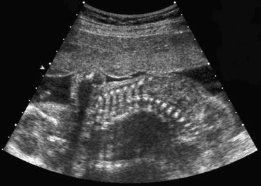 FIG 11-10, Coronal scan of the fetal spine by two-dimensional sonography showing scoliosis.