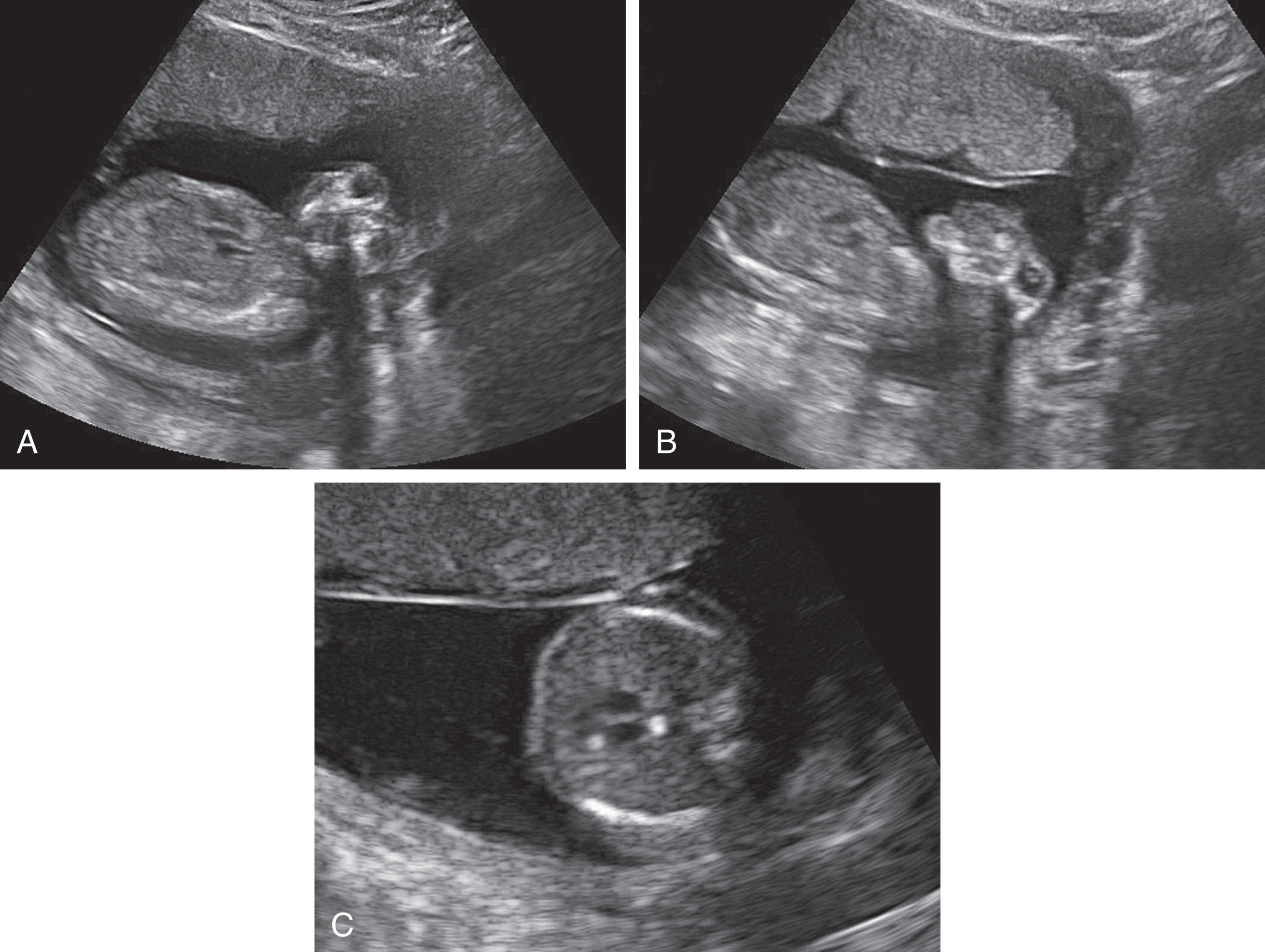 Fig. 60.1, (A) An anencephalic fetus; absence of the brain and calvarium is identified. Note the froglike appearance. (B) A profile of the anomaly. (C) Echogenic foci were noted in the heart; amniocentesis revealed trisomy 13.