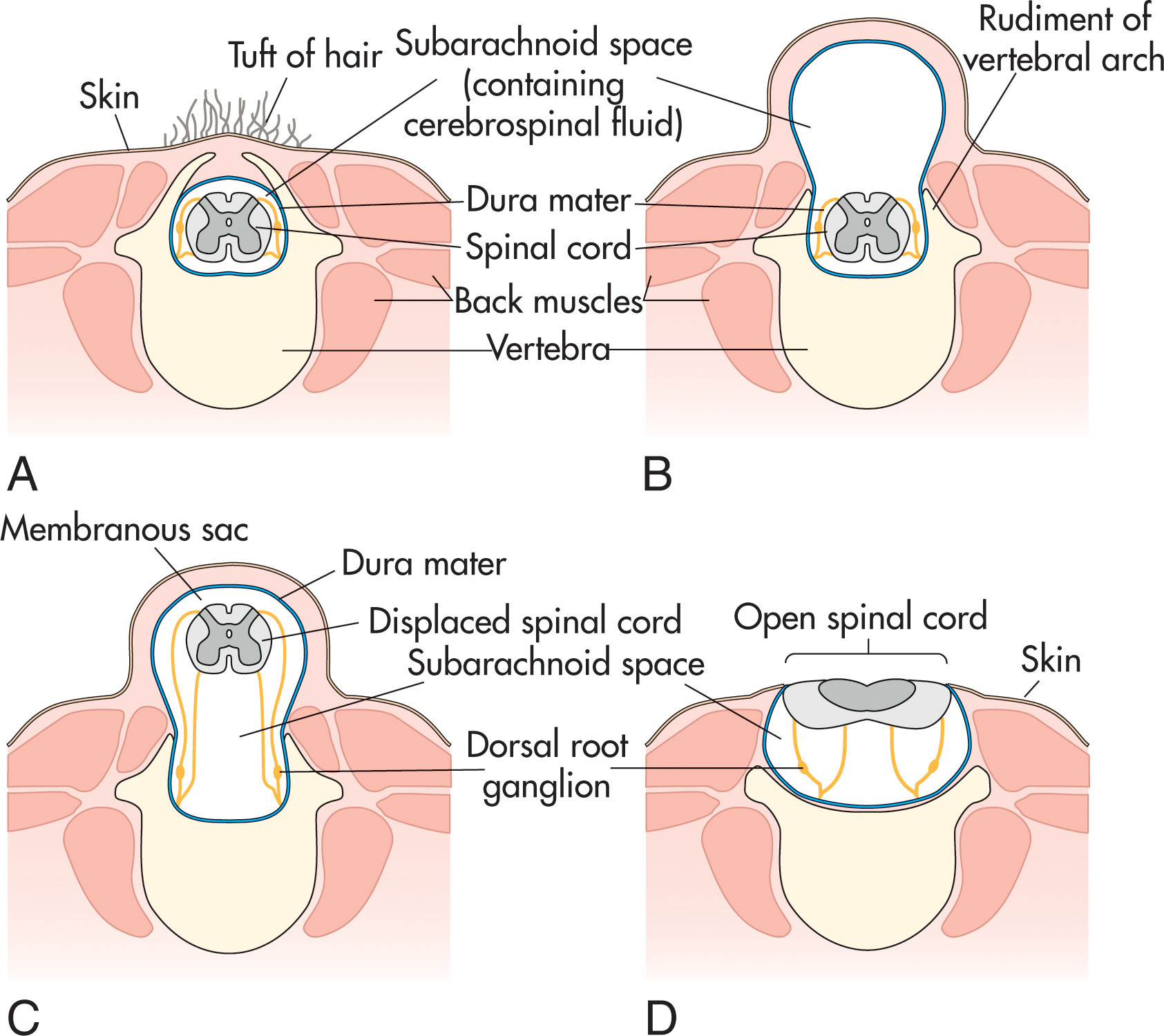 Fig. 60.12, Various types of spina bifida and commonly associated malformations of the nervous system. (A) Spina bifida occulta. Approximately 10% of people have this vertebral defect in L5 and/or S1. It usually causes no back problems. (B) Spina bifida with meningocele. (C) Spina bifida with meningomyelocele. (D) Spina bifida with myeloschisis. The types illustrated in parts B through D are often referred to collectively as spina bifida cystica because of the cystic sac that is associated with them.