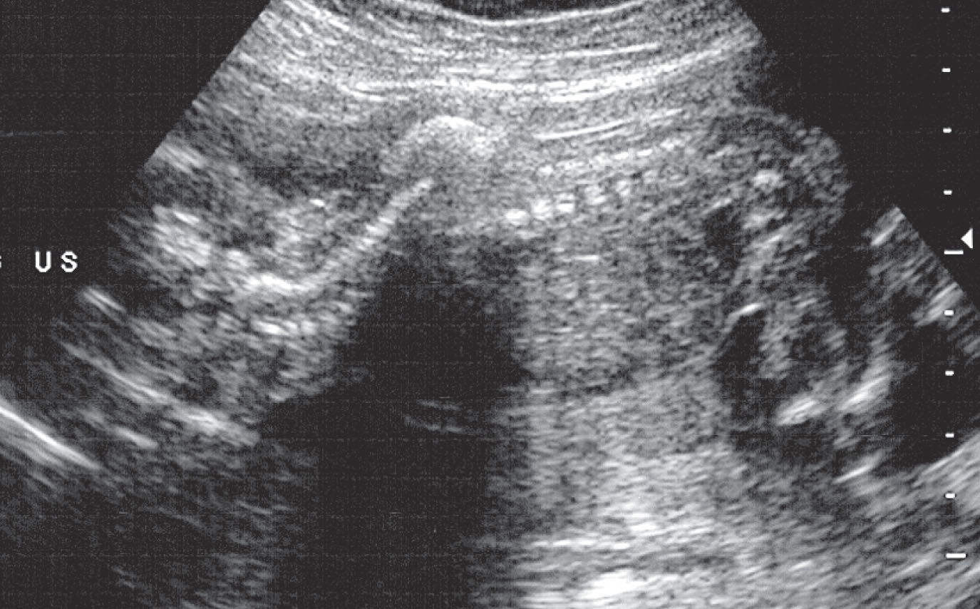 Fig. 60.13, A large spinal defect at the thoracic level is seen in the fetus. The prognosis was extremely poor.