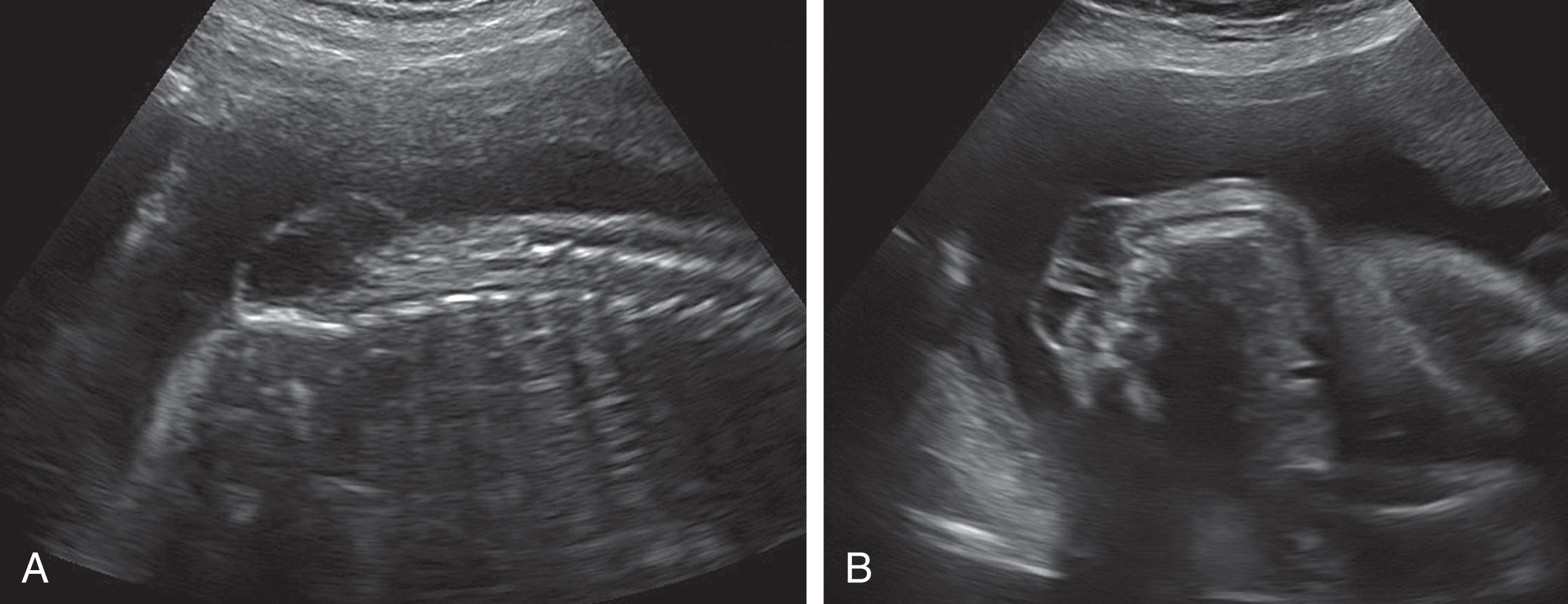 Fig. 60.14, Sagittal (A) and transverse (B) views of the fetal spine demonstrate this defect in the lumbar region consistent with a myelomeningocele.