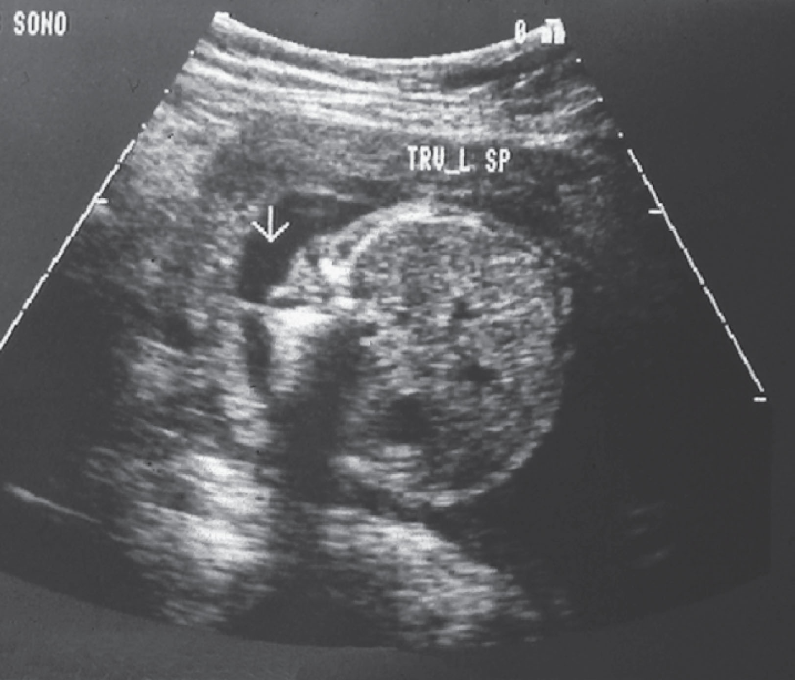 Fig. 60.15, Meningomyelocele with spinal splaying appearing as a V.