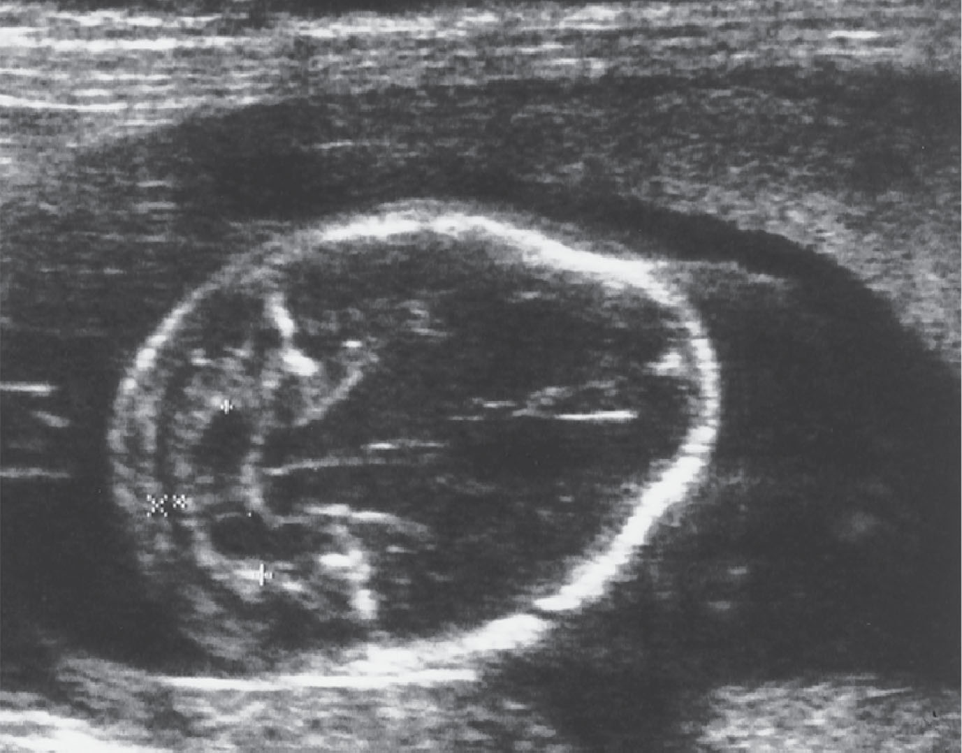 Fig. 60.18, Abnormally shaped cerebellum “banana” sign in a 21-week fetus with a lumbosacral meningomyelocele. Note the lemon-shaped frontal bones consistent with frontal bossing.