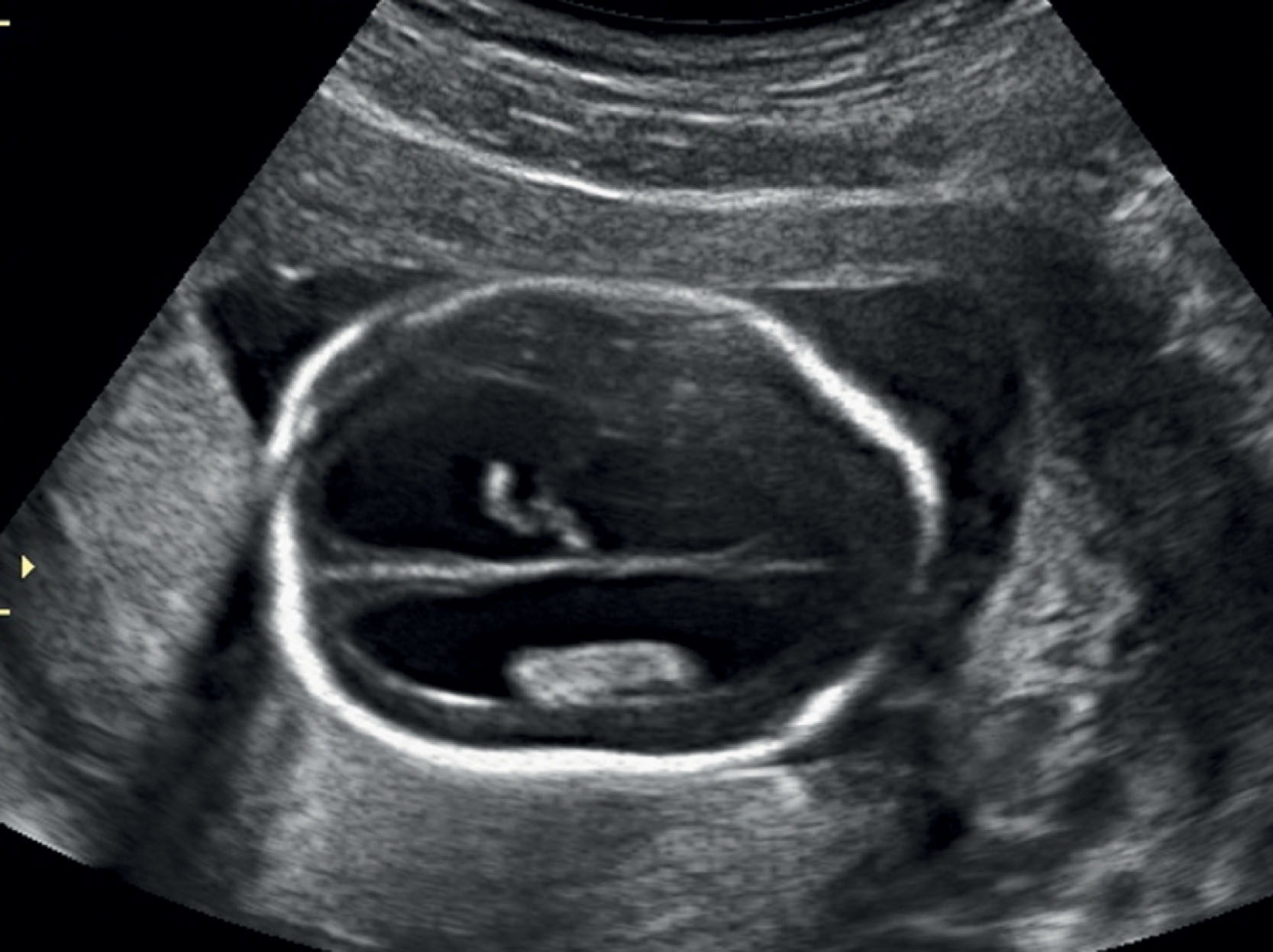 Fig. 60.19, Ventriculomegaly in a fetus with a myelomeningocele.