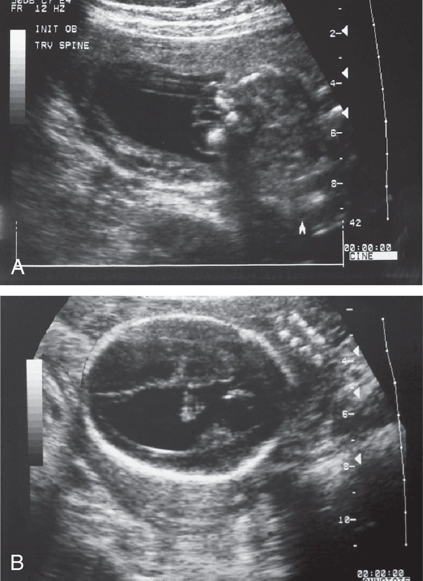 Fig. 60.20, (A) A fetus at 24.6 weeks of gestation with a meningomyelocele. Neural elements were identified in the sac. (B) A significant amount of ventricular dilation was identified within the fetal head.