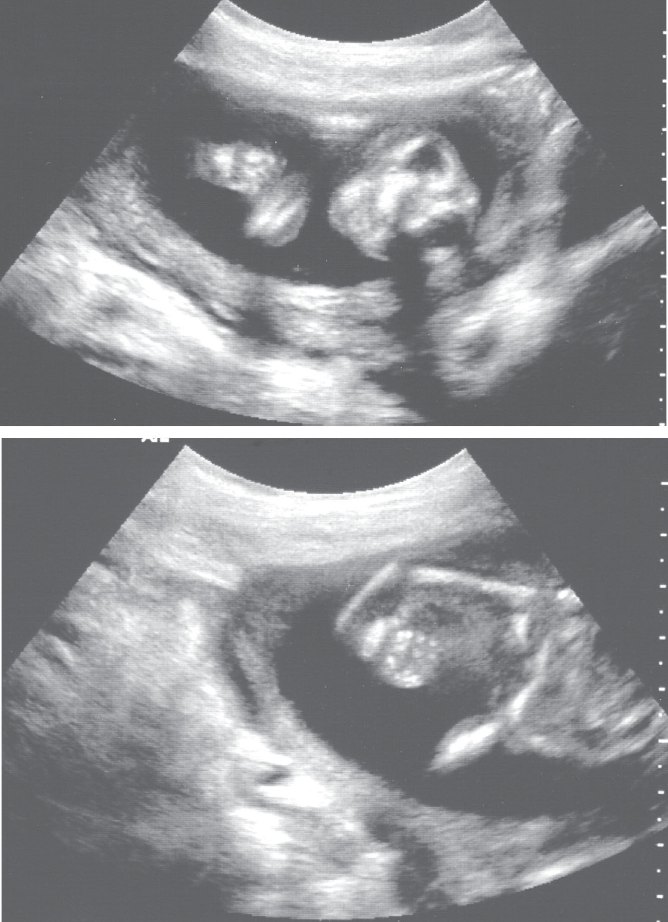 Fig. 60.3, Anencephaly was identified in a fetus with a radial ray defect and tetralogy of Fallot. A chromosomal anomaly was suspected.