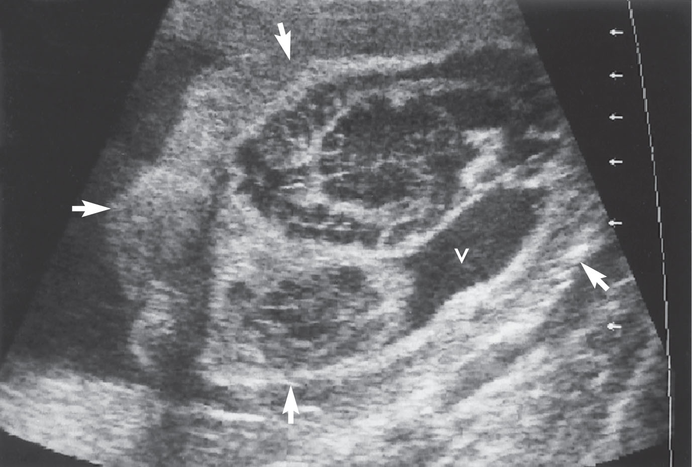 Fig. 60.6, Transverse view of a fetus showing the disorganized and freely floating brain tissue (arrows) . The brain anatomy is enhanced because of the absence of skull bones. Note the herniated ventricle (v) and sulcal markings.