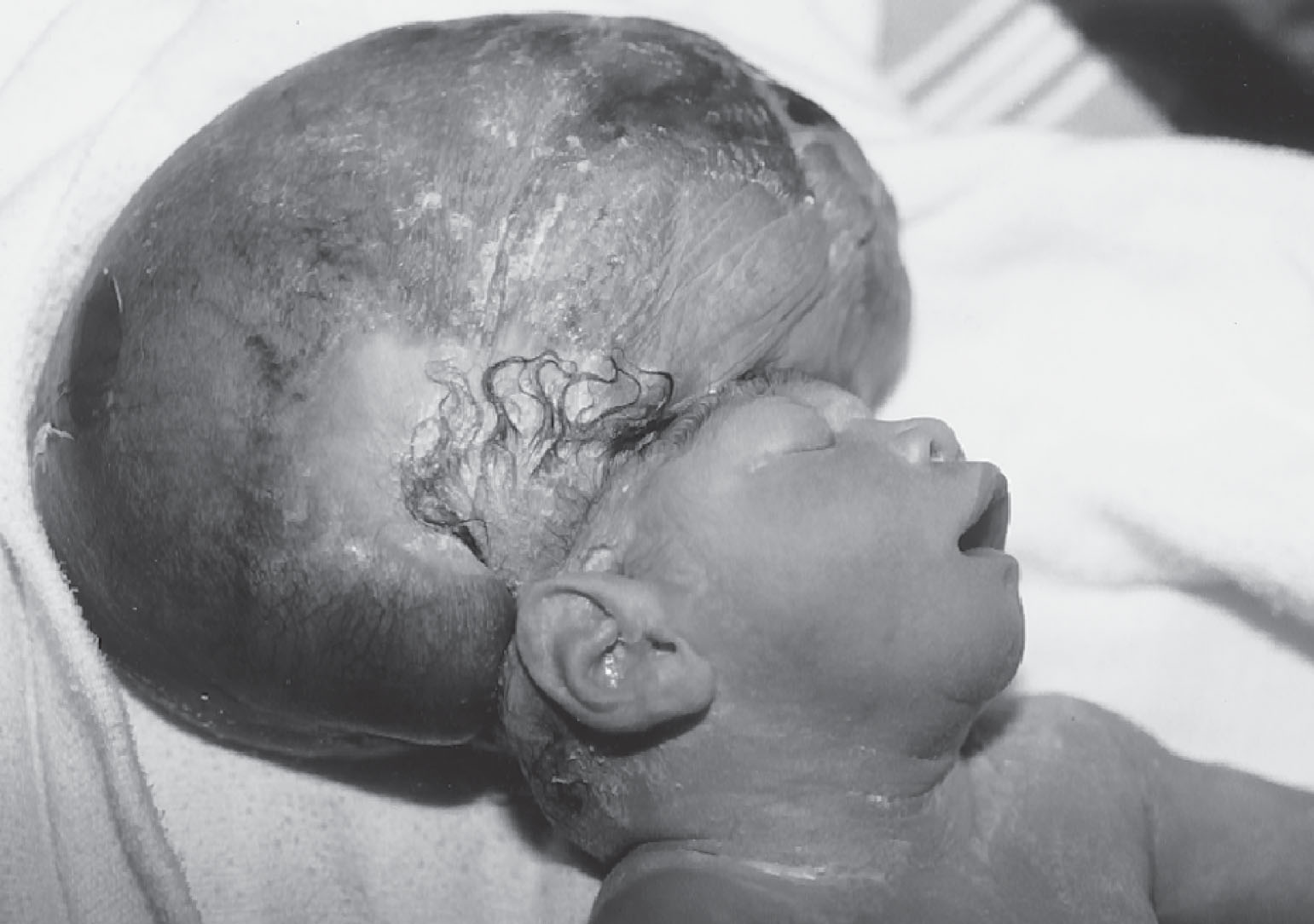 Fig. 60.7, Same neonate shown in Fig. 60.6 , with acrania shortly after birth. The infant died within a few hours.