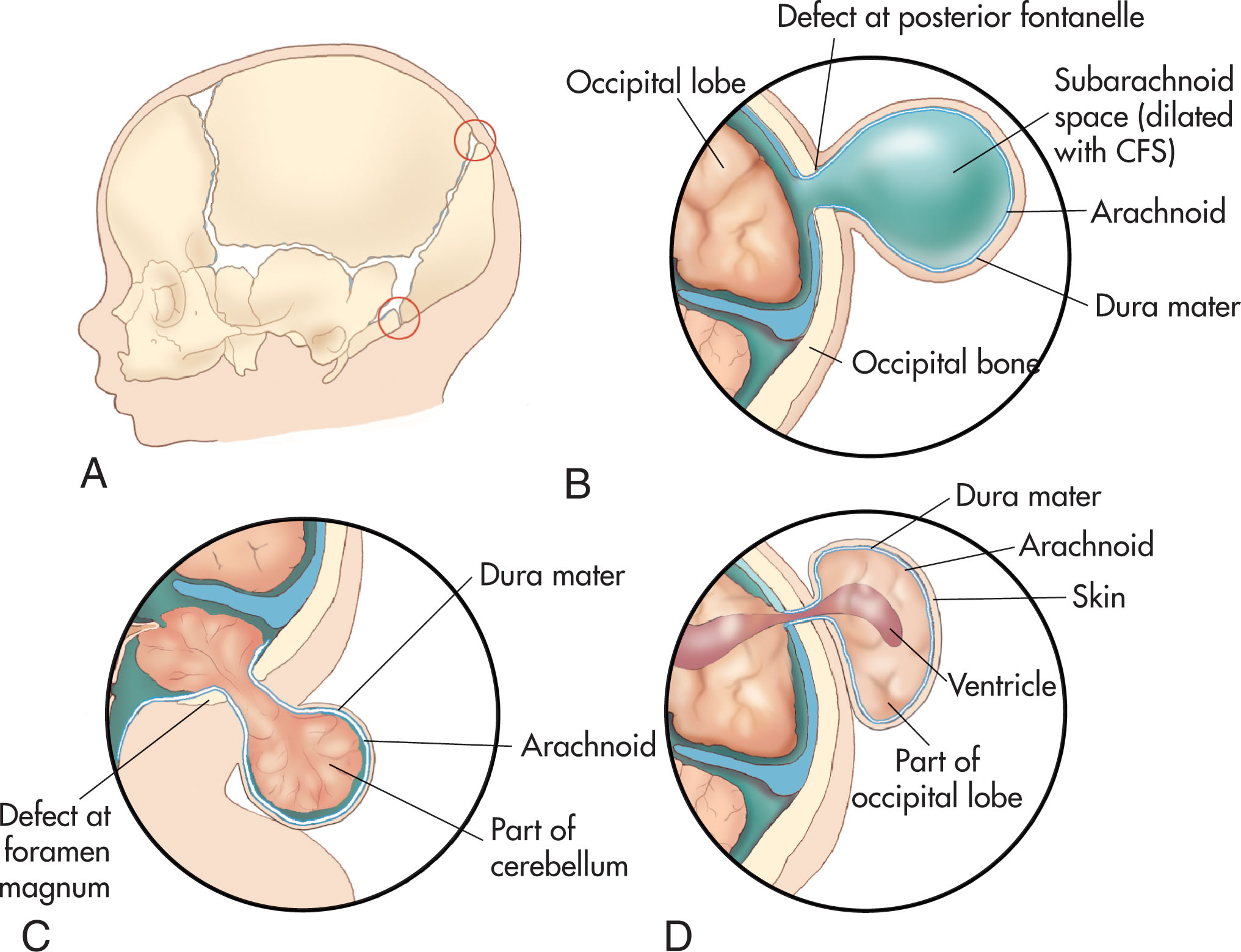 Fig. 60.8, Cranium bifidum (bony defect in the cranium) and various types of herniation of the brain and/or meninges.