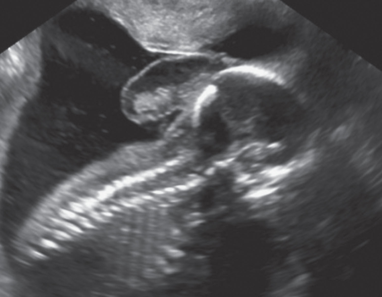 Fig. 60.10, Encephalocele.