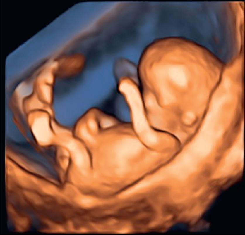 Fig. 6.3, A transvaginal 3D ultrasound (with superficial rendering) of an 11-week fetus. Note its relatively large head. The limbs are fully developed. An auricle can also be observed on the left lateral aspect of the head.