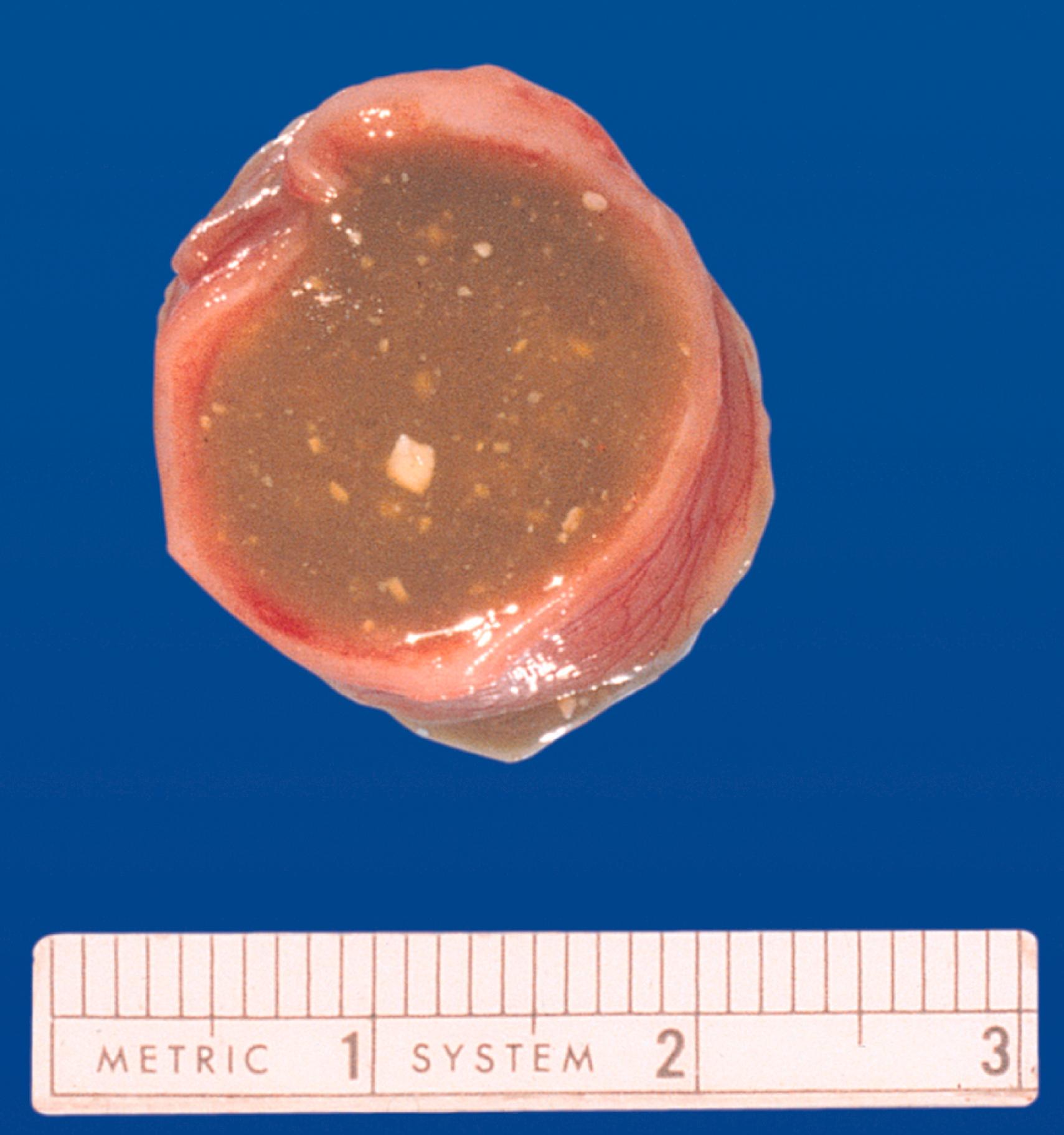 Fig. 18.9, Meconium ileus (accumulation of fetal meconium [the greenish material]) in the fetal small intestine.