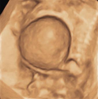 Fig. 116.3, Sagittal three-dimensional rendering of a dilated fetal bladder with keyhole sign.
