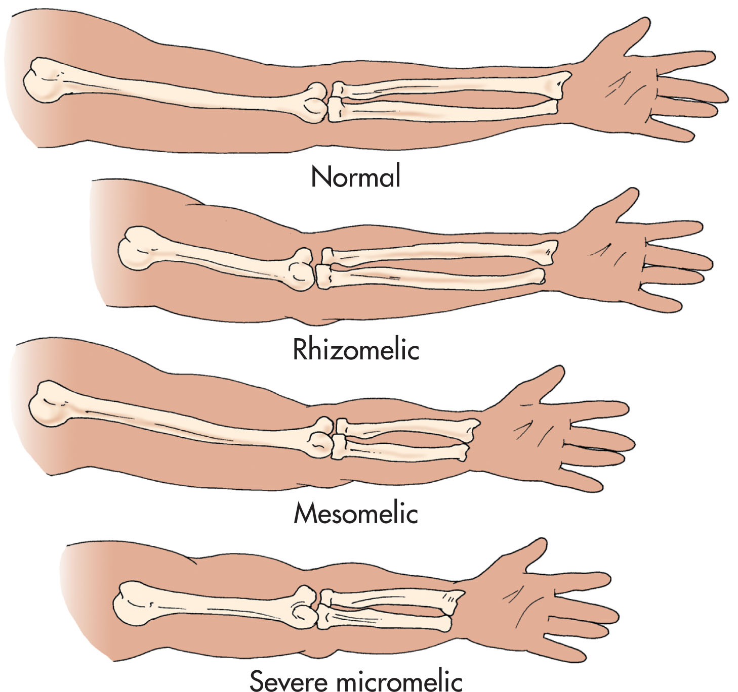 Fig. 65.1, Varieties of short-limb dysplasia according to the affected bones. Rhizomelic dysplasia is characterized by shortening of the proximal long bones (humerus and femur). Mesomelic dysplasia is described as shortening of the distal extremities (radius/ulna and tibia/fibula). Severe micromelia produces shortening of both proximal and distal extremities.