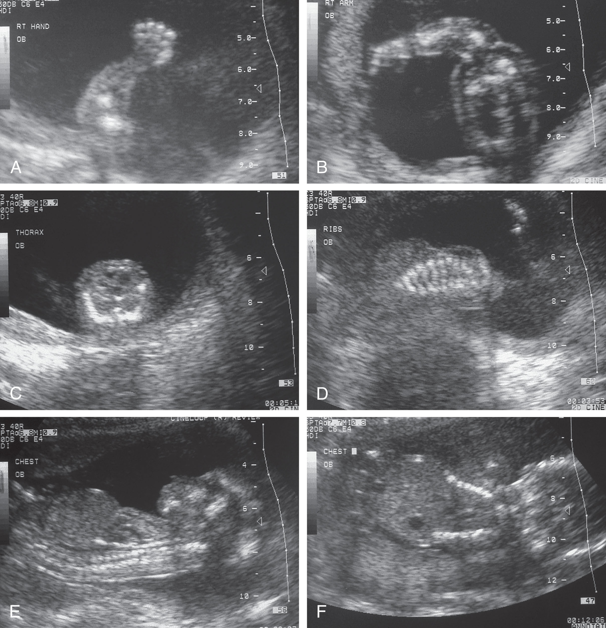 Fig. 65.3, Lethal skeletal dysplasia consistent with thanatophoric dysplasia at a gestational age of 18 weeks, 1 day.