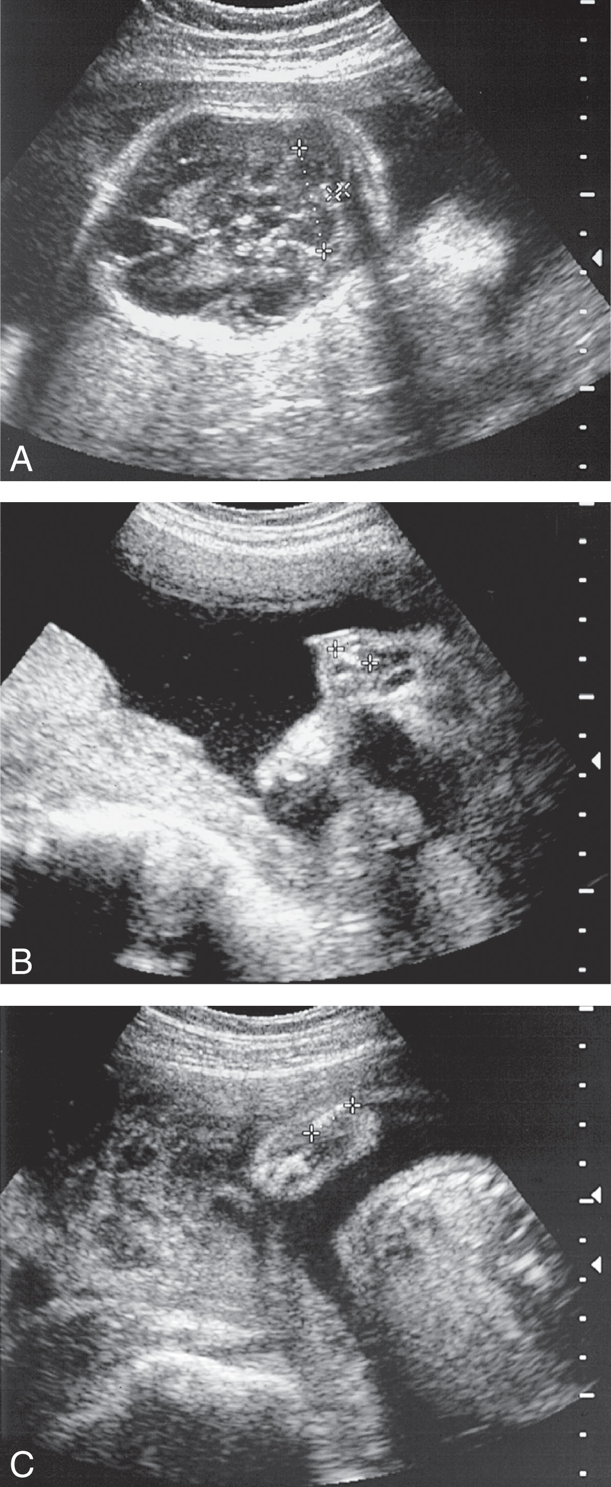 Fig. 65.4, (A) This fetus at 24 weeks of gestation presented with decreased ossification that was noted in the spine and calvarium, which was compressible. Severe micromelia is evidenced in the femur (B) and humerus (C), where the measurement was consistent with 13 weeks of gestation. Achondrogenesis was diagnosed following delivery, and the baby died shortly thereafter.