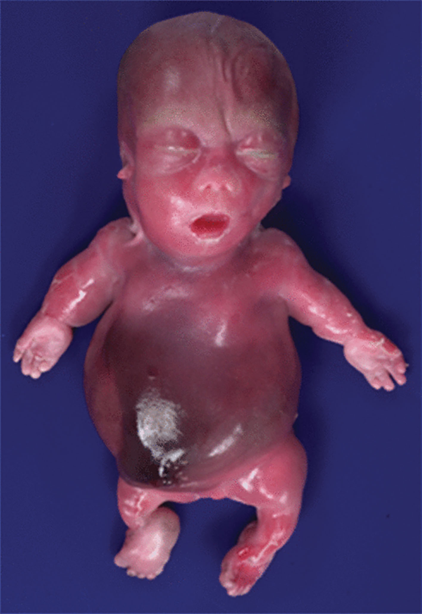 Fig. 65.6, Postmortem image of neonate with achondrogenesis type II demonstrating short barrel-shaped trunk, distended abdomen, and micromelia.