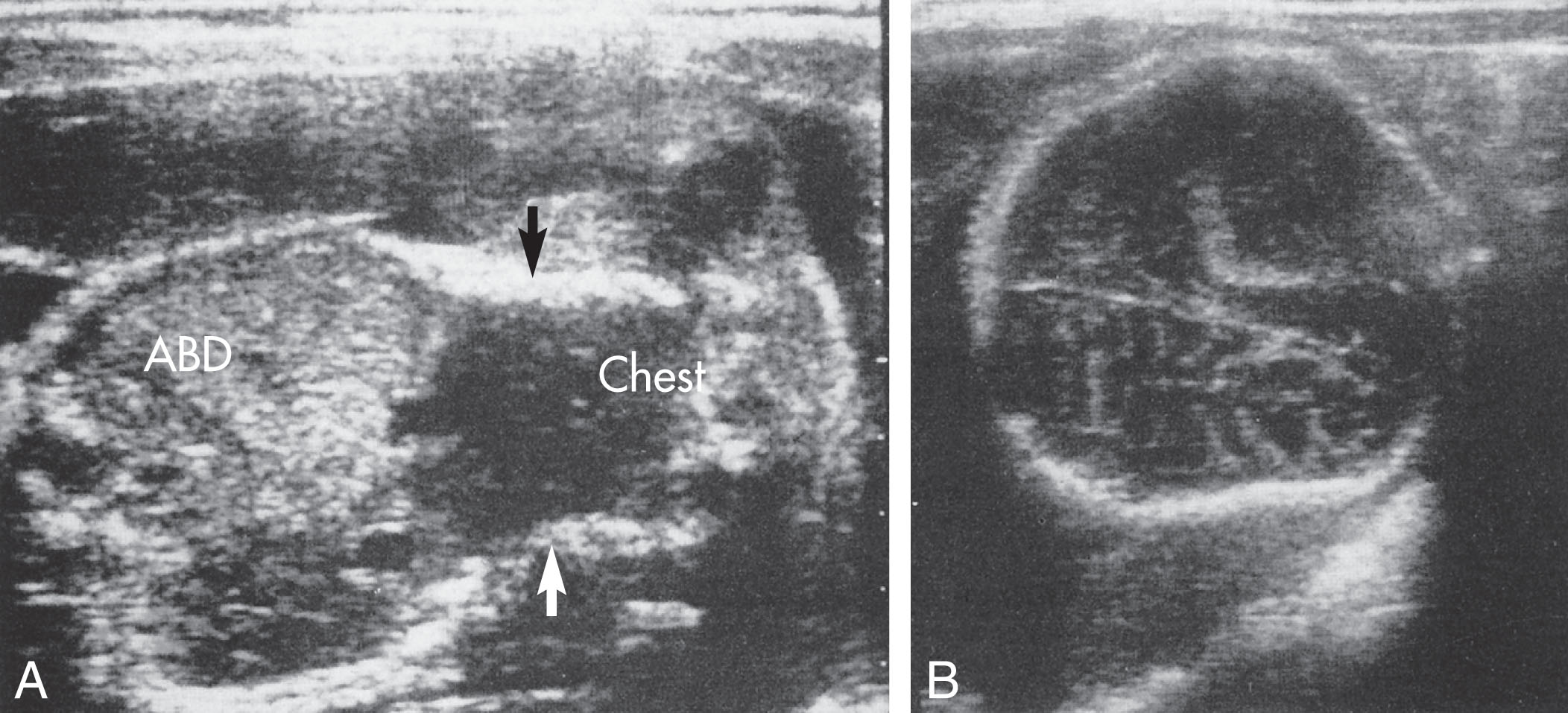 Fig. 65.8, Fetus with osteogenesis imperfecta (type II).