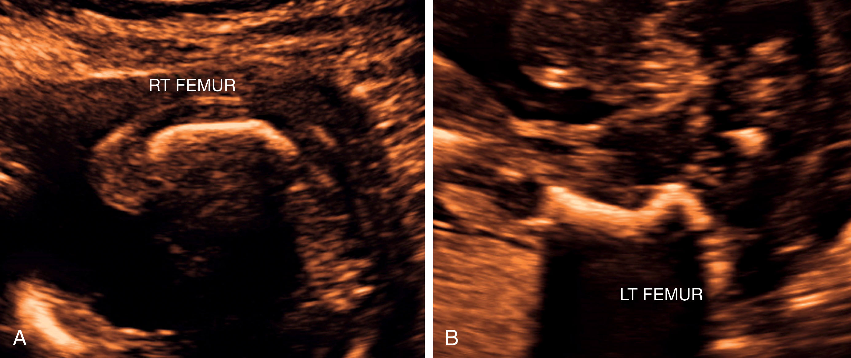 Fig. 65.9, Images of both femurs in a 20-week fetus.