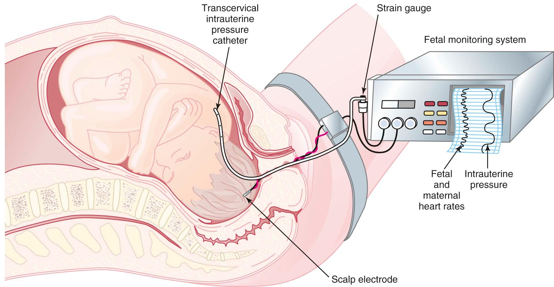 FIGURE 9-1, Technique for internal continuous electronic monitoring of both fetal and maternal heart rates, as well as the pressure and frequency of uterine contractions. External monitoring of uterine contractions provides information only about the frequency of contractions.