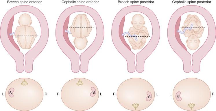 F igure 16-1, Establishing fetal right (R) and left (L): schematic representations of the gravid uterus in the coronal plane with the fetus in various orientations (top diagrams) and corresponding cross sections of the fetal abdomen at the level of the dashed lines in the upper diagrams (bottom diagrams). In each case fetal situs is normal and the stomach (S) is shown on the anatomic left side of the fetus. Far left diagrams, Breech fetus with the spine located anteriorly in the near field relative to the ultrasound transducer. Fetal left is on the left side of the image. Central left diagrams, Cephalic fetus with the spine located anteriorly in the near field relative to the ultrasound transducer. Fetal left is on the right side of the image . Central right diagrams, Breech fetus with the spine located posteriorly in the far field relative to the ultrasound transducer. Fetal left is on the right side of the image . Far right diagrams, Cephalic fetus with the spine located posteriorly in the far field relative to the ultrasound transducer. Fetal left is on left side of the image. The location of internal organs such as the stomach should not be used in the initial assessment of the fetal left and right sides, because the determination of fetal side in some fetuses with a situs abnormality will be incorrect using this method. Once the anatomic fetal left and right sides have been determined, the location of the stomach can be assessed; if the stomach is confirmed to be on the anatomic left side, the stomach can be used to identify the fetal left side during the remainder of the examination, even if the fetus moves into a different orientation.