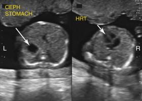 F igure 16-2, Stomach and cardiac apex: location. Axial images of the abdomen (left image) and the chest (right image) in a fetus in cephalic presentation, obtained by sliding the transducer superiorly from the abdomen to the thorax, show both the stomach (long arrow) and the cardiac apex (short arrow) on the left side of the fetus. L, Left; R, right.