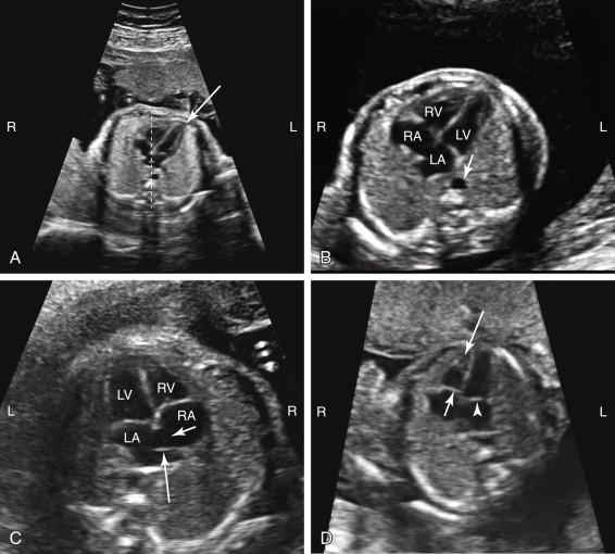 F igure 16-3, Four-chamber view: Normal features. A, Cardiac location and orientation. Four-chamber view shows the majority of heart on the left side of the chest, with cardiac apex (arrow) pointing toward the left side of the fetus at approximately 45 degrees from midline (dashed line). B, Chamber location and size. The right ventricle (RV) is the anteriormost chamber and is similar in size to the left ventricle. The left atrium (LA) is the posteriormost chamber and is similar in size to the right atrium (RA). The LA is anterior to the descending aorta (arrow). Note that the ventricles account for approximately two thirds of the size of the heart. C, Patent foramen ovale is depicted as a defect in the interatrial septum (short arrow). The flap (long arrow) opens into the LA. D, Atrioventricular valves. The tricuspid valve (short arrow) is located closer to the cardiac apex than the mitral valve (arrowhead) . Soft tissue in the apex of the RV (long arrow) corresponds to the moderator band, and helps distinguish the RV from the left ventricle. L, Left; LV, left ventricle; R, right.