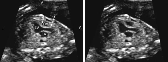 F igure 16-4, Left ventricular outflow tract (LVOT). Longitudinal view of the LV with (image A ) and without (image B ) annotation shows the LVOT arising from the left ventricle in the center of the heart. The interventricular septum (short arrow) and the anterior wall of the ascending aorta (long arrow) are in continuity with each other. A, Anterior; I, inferior; LA, left atrium; LV, left ventricle; P, posterior; RV, right ventricle; S, superior.