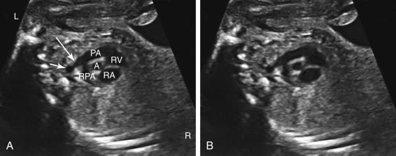 F igure 16-6, Short-axis view of the great vessels with (image A ) and without (image B ) annotation. The pulmonary artery (PA) is depicted in long axis originating from the right ventricle (RV) and curving around the ascending aorta (A). The ascending aorta is shown in cross section. The PA and aorta are similar in caliber. Also seen are the right PA (RPA) and the ductus arteriosus (long arrow) extending from the main PA to the descending aorta (short arrow) . L, Left; R, right; RA, right atrium.