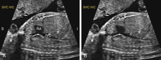 F igure 16-7, Inferior vena cava (IVC)/superior vena cava (SVC) view. Longitudinal view of the thorax with (image A ) and without (image B ) annotation shows the IVC and the SVC emptying into right atrium (RA). I, Inferior; S, superior.