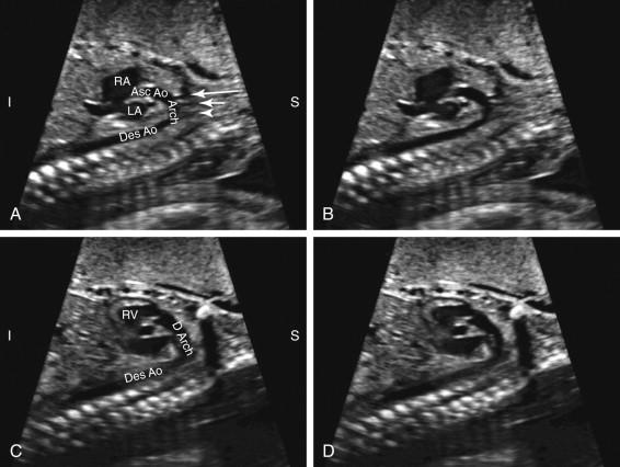 F igure 16-8, Aortic arch versus ductal arch. A and B, Aortic arch. Longitudinal image of the aortic arch with (image A ) and without (image B ) annotation depicts ascending aorta (Asc Ao) arising from the middle of the heart to connect with the aortic arch (Arch), which exhibits a curved candy-cane configuration. Branches including the innominate artery (long arrow) , left common carotid artery (short arrow), and left subclavian artery (arrowhead) arise from the aortic arch and course superiorly. C and D, Ductal arch. Longitudinal image of ductal arch with (C) and without (D) annotation depicts ductal arch (D Arch) arising from the anterior portion of the heart and coursing posteriorly to connect with the descending aorta. The ductal arch exhibits a flattened hockey-stick shape rather than the curved configuration of the aortic arch. Note the absence of branches arising from the superior surface of the ductal arch. Des Ao, Descending aorta; I, inferior; LA, left atrium; RA, right atrium; RV, right ventricle; S, superior.