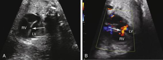 F igure 16-9, Ventricular septal defect (VSD). A, Gray-scale image of the heart demonstrates a defect in the ventricular septum (arrow) . B, Color Doppler image in a different scan plane reveals blood flow through the defect in the ventricular septum (arrow) , confirming that the VSD is real and not due to artifactual dropout of sound. RV, Right ventricle; LV, left ventricle.