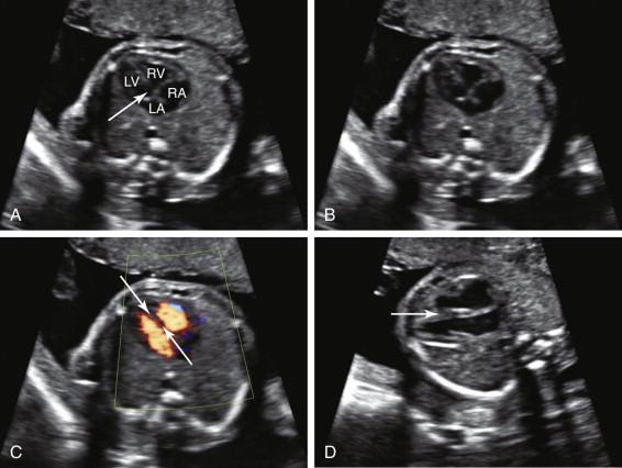 F igure 16-10, Apparent ventricular septal defect due to the scan plane. A and B, Apical four-chamber view of the heart with (image A ) and without (image B ) annotation demonstrates an apparent defect (arrow) in the interventricular septum. C, Color Doppler four-chamber view in a similar scan plane to image A shows blood flow filling both ventricles with no evidence of flow crossing the interventricular septum (arrows) . D, Subcostal four-chamber view of the same fetus facilitates visualization of the interventricular septum (arrow) in an orthogonal scan plane to image A , further confirming that the septum is intact. LA, Left atrium; LV, left ventricle; RA, right atrium; RV, right ventricle.