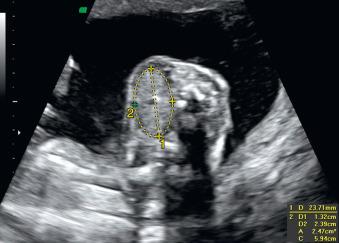 Fig. 72.2, Measurements in a fetal goiter on an axial slice. (1) Goiter diameter; (2) circumference and area. Nomograms should be used to determine if the thyroid is enlarged.