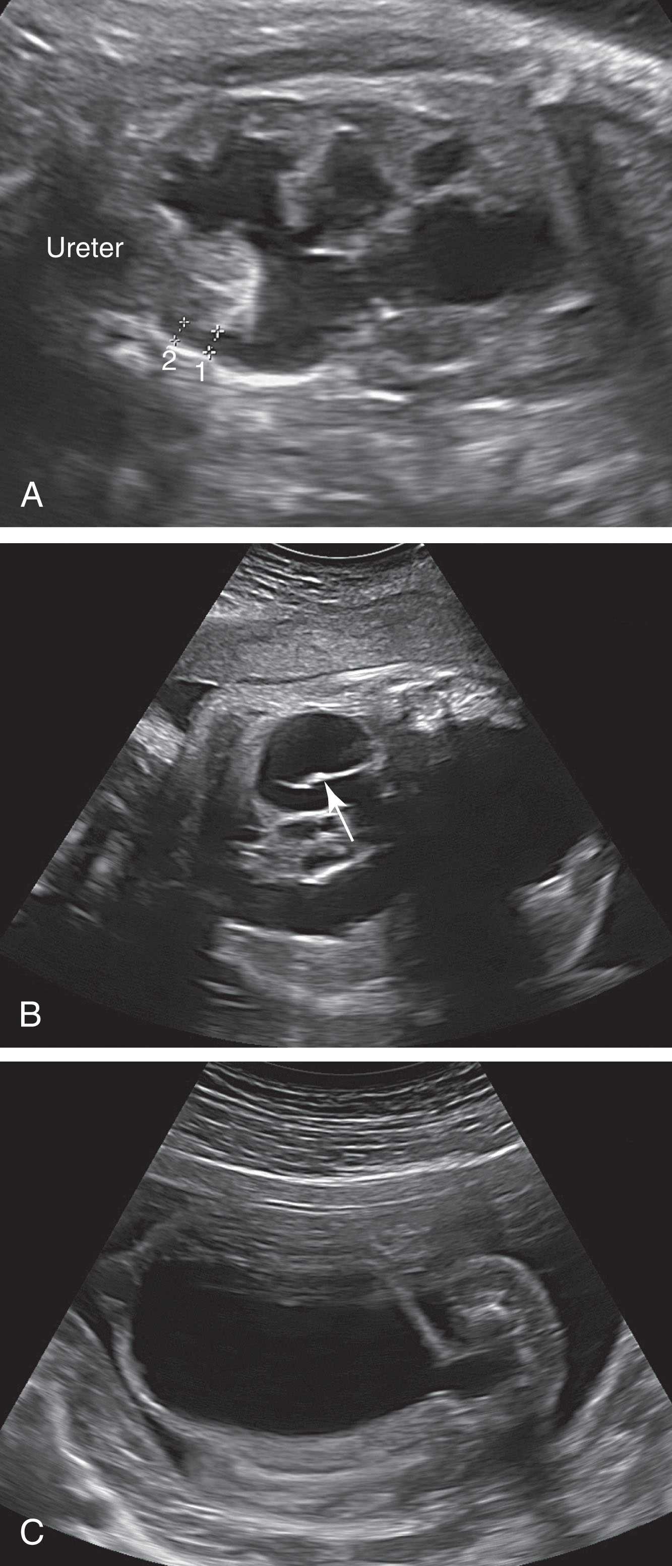 Fig. 64.11, (A) The kidney in this fetus reflects dilation of ureter, renal pelvis, and calyces. (B) Image of a dilated tortuous ureter. (C) The signature keyhole sign is noted in this enlarged bladder and urethra.